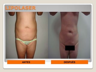 LIPOLASER




     ANTES   DESPUÉS
 