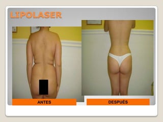 LIPOLASER




    ANTES   DESPUÉS
 