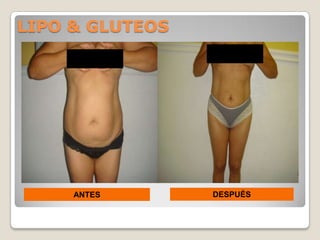 LIPO & GLUTEOS




     ANTES       DESPUÉS
 