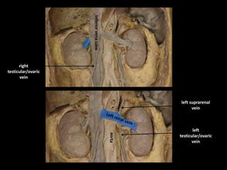left suprarenal
vein
left
testicular/ovaric
vein
right
testicular/ovaric
vein
Inferior
vena
cava
 