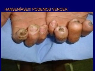 HANSENÍASE!!! PODEMOS VENCER.
 
