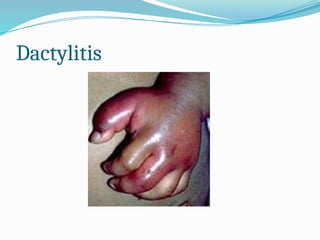 Dactylitis
 