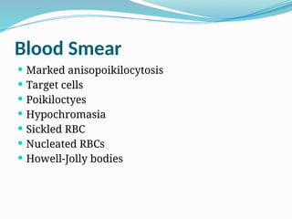 Blood Smear
 Marked anisopoikilocytosis
 Target cells
 Poikiloctyes
 Hypochromasia
 Sickled RBC
 Nucleated RBCs
 Howell-Jolly bodies
 