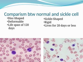 Comparism btw normal and sickle cell
•Disc-Shaped
•Deformable
•Life span of 120
days
•Sickle-Shaped
•Rigid
•Lives for 20 days or less
 