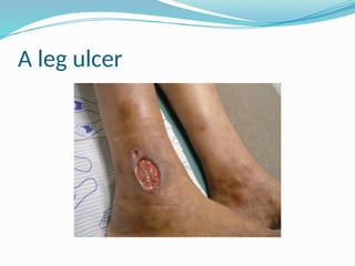 A leg ulcer
 