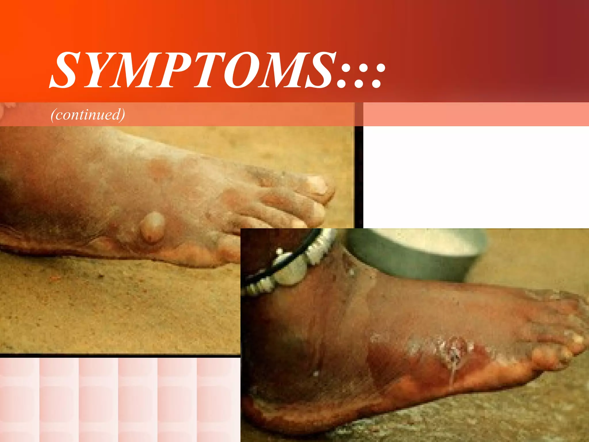 Dracunculiasis Dracunculus Medinensis guinea Worm Disease PPT