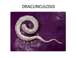 DRACUNCULOSIS
 