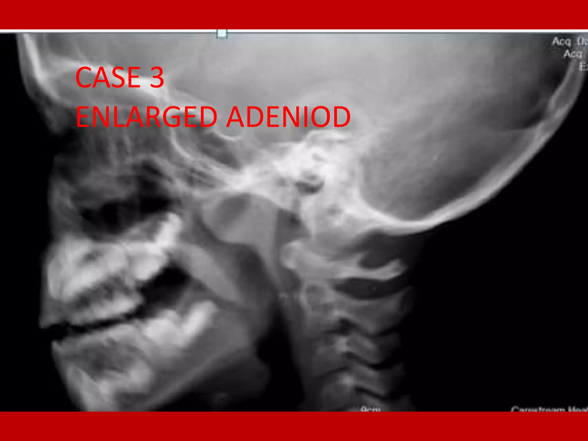 Dr Ahmed Esawy Imaging Of Adeniod Enlargment PDF dr-ahmed-esawy-imaging-of-adeniod-enlargment-pdf