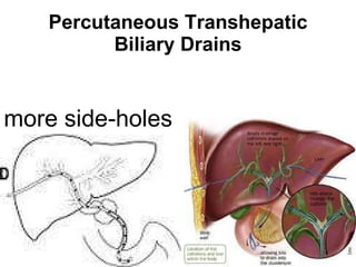 Percutaneous Transhepatic Biliary Drains more side - holes 