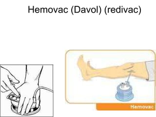 Hemovac (Davol) (redivac)  