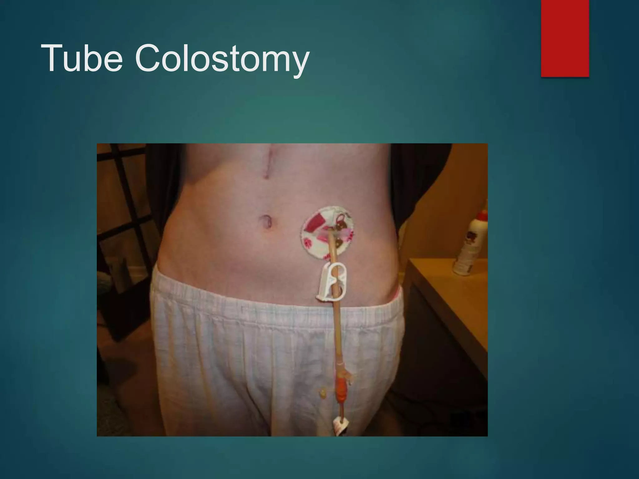 DRAINS AND DRAINAGE SYSTEMS IN SURGERY PPT - Corrected.ppt