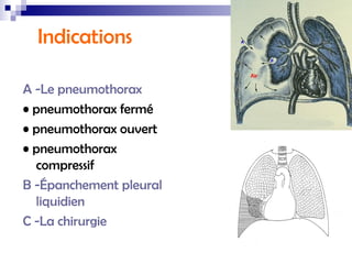 Drain Thoracique Pneumothorax – Drain Thoracique – ALIS