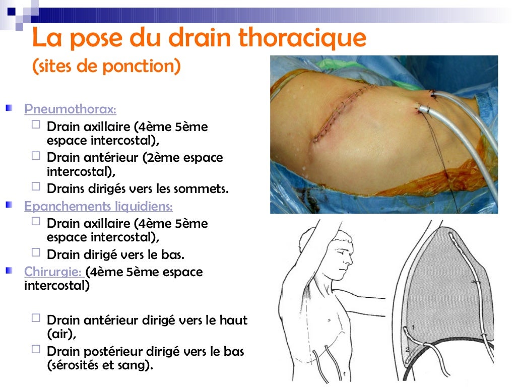 Drainage thoracique