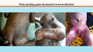 Malnutrition, protein Energy Malnutrition, overnutrition/Obesity ...