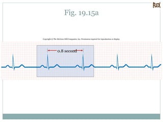Fig. 19.15a
Copyright © The McGraw-Hill Companies, Inc. Permission required for reproduction or display.
0.8 second
 