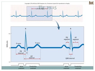 Fig. 19.15
Copyright © The McGraw-Hill Companies, Inc. Permission required for reproduction or display.
0
Millivolts
R R
Q
S
0.8 second
+1
–1
Atria
contract
Ventricles
contract
Atria
contract
Ventricles
contract
ST
segment
PQ
segment
QRS interval
T waveP wave
PR
interval
QT
interval
 