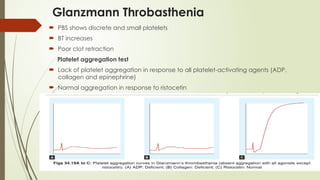 Glanzmann Throbasthenia
 PBS shows discrete and small platelets
 BT increases
 Poor clot retraction
Platelet aggregation test
 Lack of platelet aggregation in response to all platelet-activating agents (ADP,
collagen and epinephrine)
 Normal aggregation in response to ristocetin
 