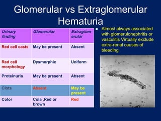 Glomerular vs Extraglomerular
Hematuria
Urinary
finding
Glomerular Extraglom-
erular
Red cell casts May be present Absent
Red cell
morphology
Dysmorphic Uniform
Proteinuria May be present Absent
Clots Absent May be
present
Color Cola ,Red or
brown
Red
◼ Almost always associated
with glomerulonephritis or
vasculitis Virtually exclude
extra-renal causes of
bleeding
 