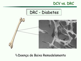 DRC - Diabetes
DCV vs. DRC
Doença de Baixo Remodelamento
 