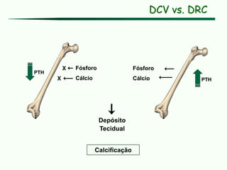 Cálcio
Fósforo
PTH
PTH
Calcificação
Depósito
Tecidual
Cálcio
Fósforo
X
X
DCV vs. DRC
 