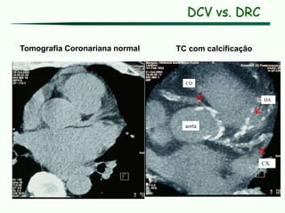 Tomografia Coronariana normal TC com calcificação
aorta
CD
CX
DA



DCV vs. DRC
 