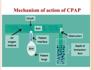 Non-invasive Ventilation (CPAP) in Newborns | PPT
