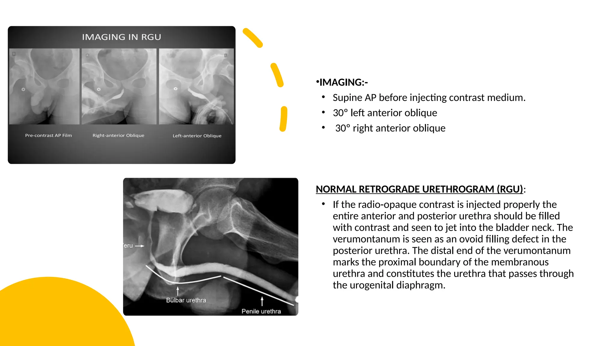 •IMAGING:-
• Supine AP before injecting contrast medium.
• 30º left anterior oblique
• 30º right anterior oblique
NORMAL RETROGRADE URETHROGRAM (RGU):
• If the radio-opaque contrast is injected properly the
entire anterior and posterior urethra should be filled
with contrast and seen to jet into the bladder neck. The
verumontanum is seen as an ovoid filling defect in the
posterior urethra. The distal end of the verumontanum
marks the proximal boundary of the membranous
urethra and constitutes the urethra that passes through
the urogenital diaphragm.
 