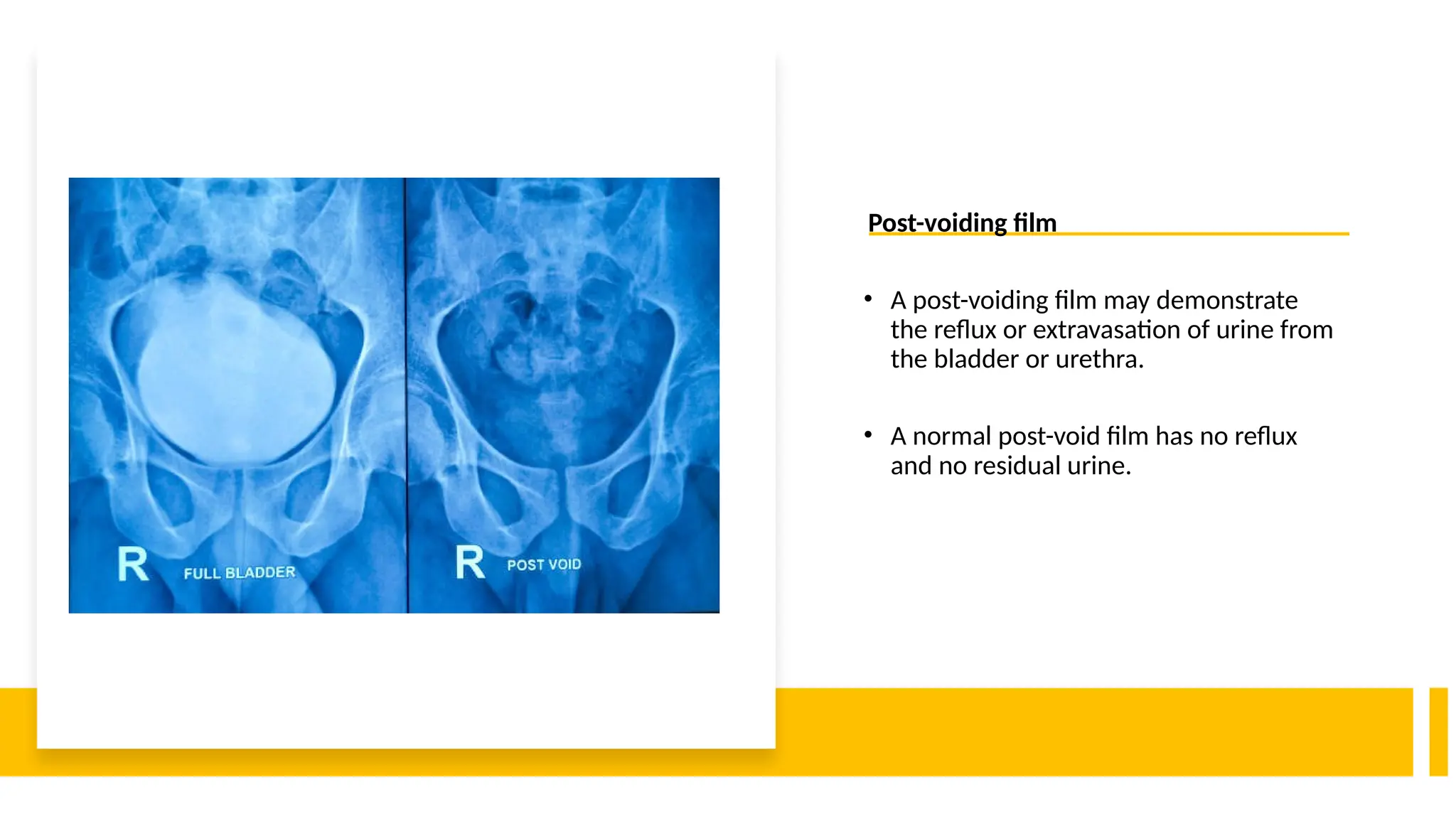 Post-voiding film
• A post-voiding film may demonstrate
the reflux or extravasation of urine from
the bladder or urethra.
• A normal post-void film has no reflux
and no residual urine.
 