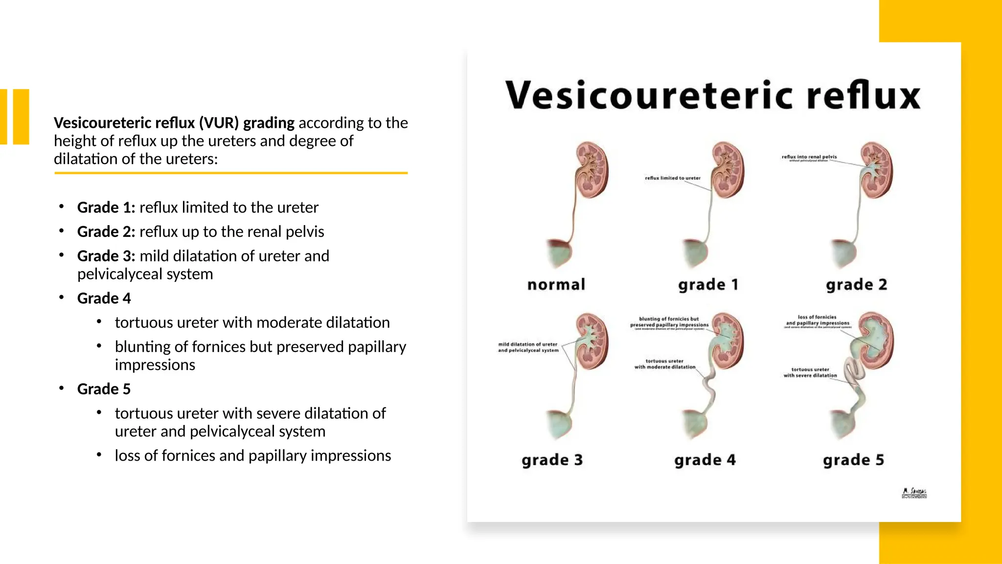 Vesicoureteric reflux (VUR) grading according to the
height of reflux up the ureters and degree of
dilatation of the ureters:
• Grade 1: reflux limited to the ureter
• Grade 2: reflux up to the renal pelvis
• Grade 3: mild dilatation of ureter and
pelvicalyceal system
• Grade 4
• tortuous ureter with moderate dilatation
• blunting of fornices but preserved papillary
impressions
• Grade 5
• tortuous ureter with severe dilatation of
ureter and pelvicalyceal system
• loss of fornices and papillary impressions
 