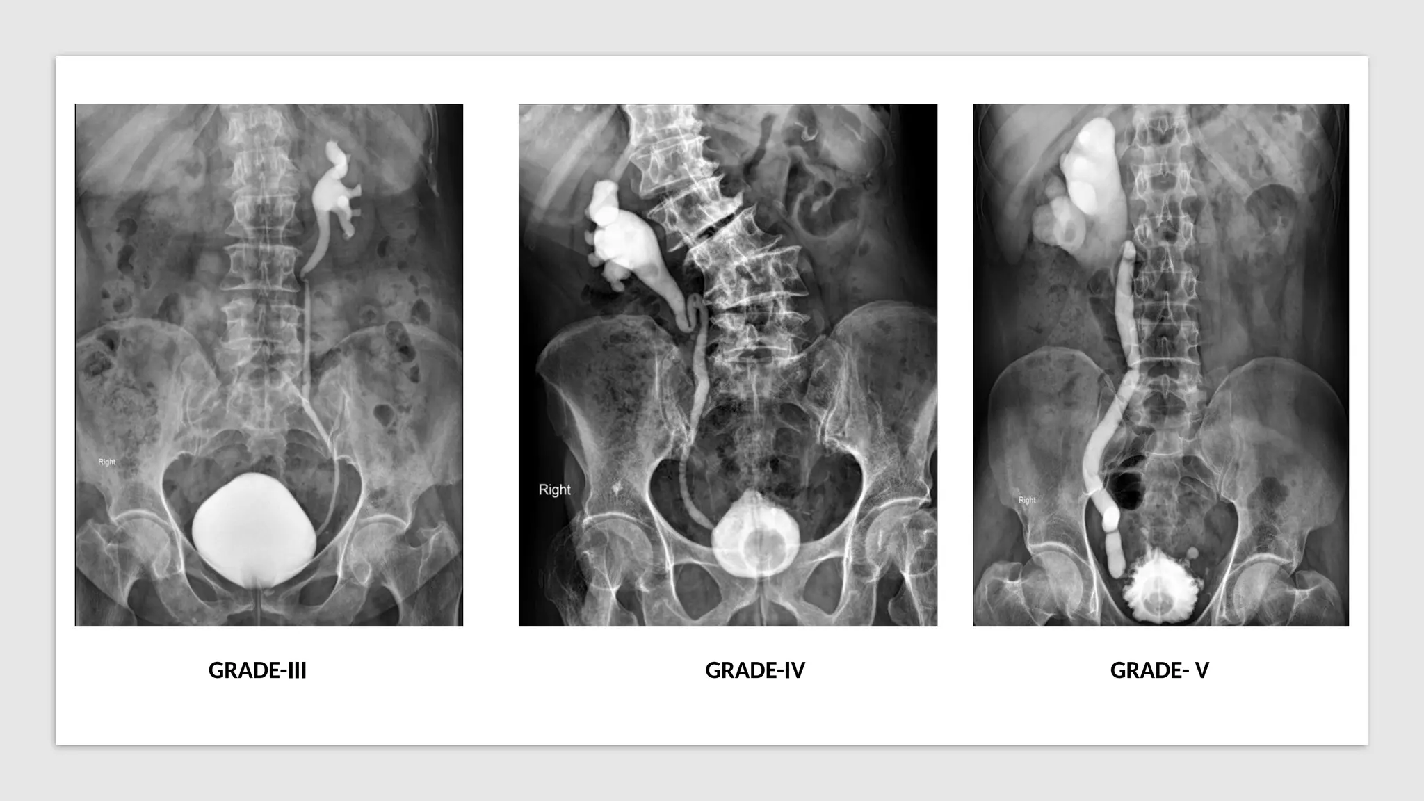 GRADE-III GRADE-IV GRADE- V
 