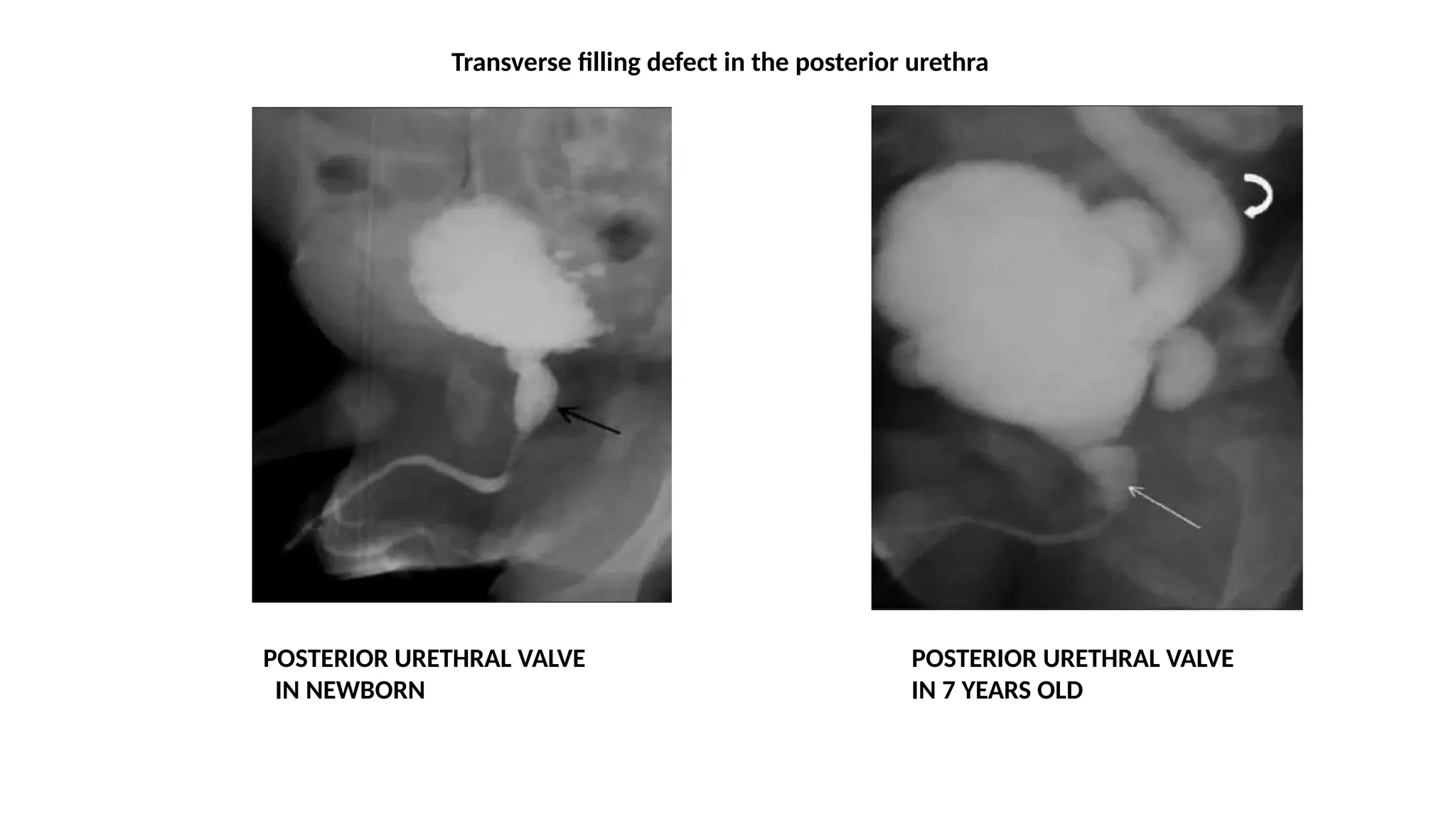 POSTERIOR URETHRAL VALVE
IN NEWBORN
POSTERIOR URETHRAL VALVE
IN 7 YEARS OLD
Transverse filling defect in the posterior urethra
 