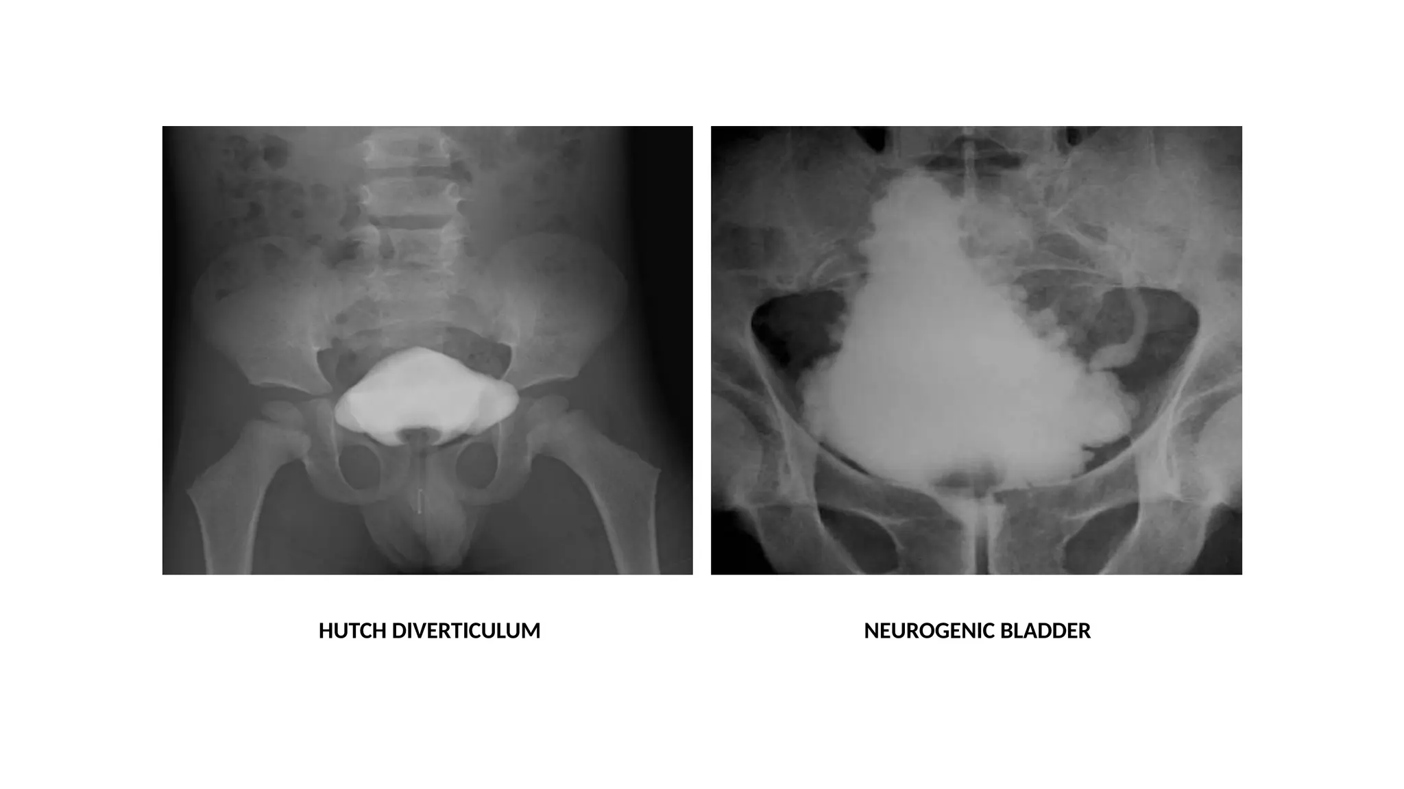 HUTCH DIVERTICULUM NEUROGENIC BLADDER
 