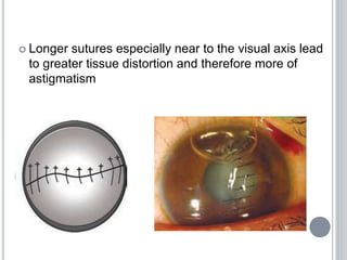  Longer sutures especially near to the visual axis lead
to greater tissue distortion and therefore more of
astigmatism
 