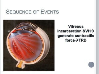 SEQUENCE OF EVENTS
Vitreous
incarceration &VH
generate contractile
forceTRD
 