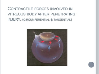 CONTRACTILE FORCES INVOLVED IN
VITREOUS BODY AFTER PENETRATING
INJURY. (CIRCUMFERENTIAL & TANGENTIAL)
 