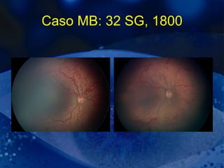 Caso MB: 32 SG, 1800 