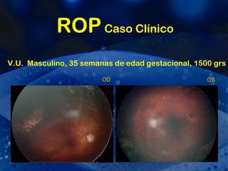 ROP  Caso Clínico V.U.  Masculino, 35 semanas de edad gestacional, 1500 grs OD OS 