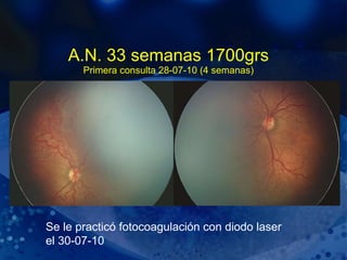 A.N. 33 semanas 1700grs Primera consulta 28-07-10 (4 semanas) Se le practicó fotocoagulación con diodo laser el 30-07-10 