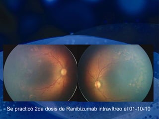 Se practicó 2da dosis de Ranibizumab intravítreo el 01-10-10 