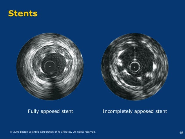 IVUS Image Interpretation and Analysis