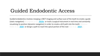 Guided Endodontic Access
Guided endodontics involves merging a CBCT imaging and surface scan of the tooth to create a guide
(static navigation) (Buchgreitz et al., 2019a) or track a surgical instrument in real time and constantly
visualizing its position (dynamic navigation) in order to create a drill path into the tooth (Moreno-
Rabié et al., 2020) or design a path to reach the apical portion of the root (Fan et al., 2019).
 