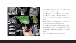 (a) Radiographic aspects of a maxillary first molar with pulp
canal obliteration in all root canals.
(b–f) Digital planning of a static guide using CBCT and oral
scanning. After merging the images, a virtual copy of the drill
used for the access preparation was superimposed on the root
canals;
(g) Printed guides for individually accessing the root canals
(mesiobuccal, distobuccal, and palatal canals);
(h) Drilling the root canals; (i) Clinical aspect after guided-
access preparation showing the three accessed root canals;
(k) Radiographic image showing the prepared and filled root
canals
(Courtesy of Dr. Warley Luciano Fonseca Tavares)
 
