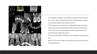 (a) Tomographic images of a symptomatic maxillary central left incisor
with chronic apical periodontitis and pulp canal obliteration showing
the access planning with the Navident system;
(b–e) Preoperatory tomographic and radiographic images showing a
patent apical canal, the obliteration of the coronal and middle canal
thirds, and an apical lesion located at the mesial aspect of the root
associated with a large lateral canal;
(f) The use of the dynamic Navident system allowed to locate, prepare,
and
(g) fill the root canal through a conservative access cavity (Courtesy of
Dr. Felipe Restrepo)
 