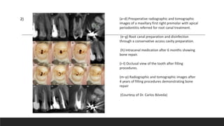 2) (a–d) Preoperative radiographic and tomographic
images of a maxillary first right premolar with apical
periodontitis referred for root canal treatment.
(e–g) Root canal preparation and disinfection
through a conservative access cavity preparation.
(h) Intracanal medication after 6 months showing
bone repair.
(i–l) Occlusal view of the tooth after filling
procedures.
(m–p) Radiographic and tomographic images after
4 years of filling procedures demonstrating bone
repair
(Courtesy of Dr. Carlos Bóveda)
 
