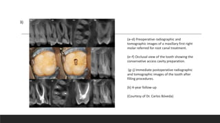 3)
(a–d) Preoperative radiographic and
tomographic images of a maxillary first right
molar referred for root canal treatment.
(e–f) Occlusal view of the tooth showing the
conservative access cavity preparation.
(g–j) Immediate postoperative radiographic
and tomographic images of the tooth after
filling procedures.
(k) 4-year follow-up
(Courtesy of Dr. Carlos Bóveda)
 
