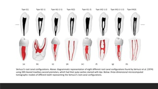 Type I(1) Type II(2-1) Type III(1-2-1) Type IV(2) Type V(1-2) Type VI(2-1-2) Type VII(1-2-1-2) Type VIII(3)
(a) (b) (c) (d) (e) (f) (g) (h)
Vertucci’s root canal configurations. Above: diagrammatic representation of eight different root canal configurations found by Vertucci et al. (1974)
using 200 cleared maxillary second premolars, which had their pulp cavities stained with dye. Below: three-dimensional microcomputed
tomographic models of different teeth representing the Vertucci’s root canal configurations.
 