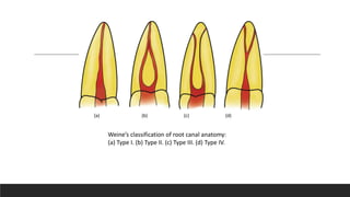 Weine’s classification of root canal anatomy:
(a) Type I. (b) Type II. (c) Type III. (d) Type IV.
(a) (b) (c) (d)
 
