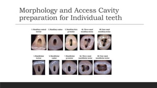Morphology and Access Cavity
preparation for Individual teeth
 