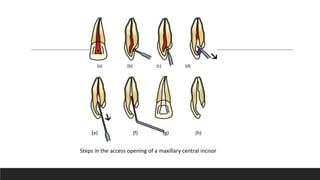 Steps in the access opening of a maxillary central incisor
(a) (b) (c) (d)
(e) (f) (g) (h)
 