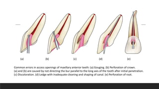 Common errors in access openings of maxillary anterior teeth: (a) Gouging. (b) Perforation of crown.
(a) and (b) are caused by not directing the bur parallel to the long axis of the tooth after initial penetration.
(c) Discoloration. (d) Ledge with inadequate cleaning and shaping of canal. (e) Perforation of root.
(a) (b) (c) (d) (e)
 